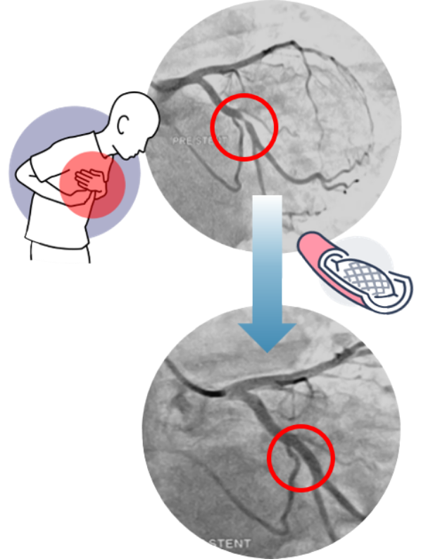 Coronary angiography and heart-stenting illustration from the supplied template